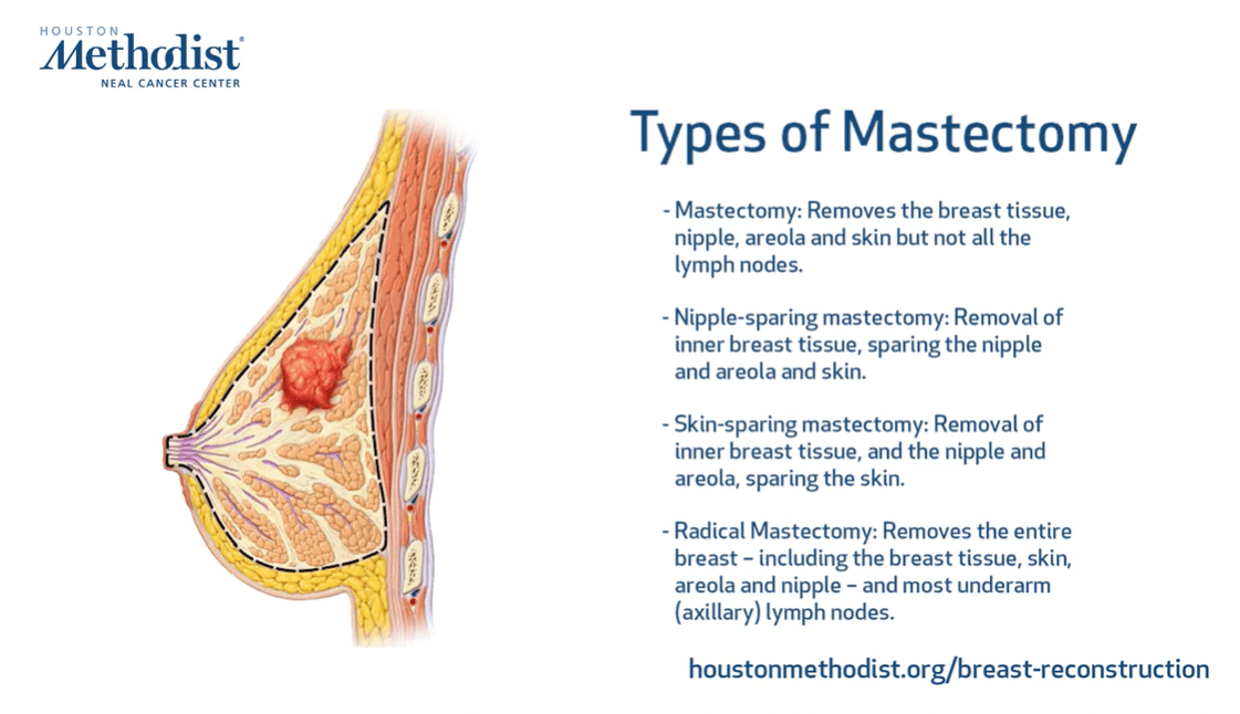 Video link showing breast illustration with a list of the types of mastectomies we offer.