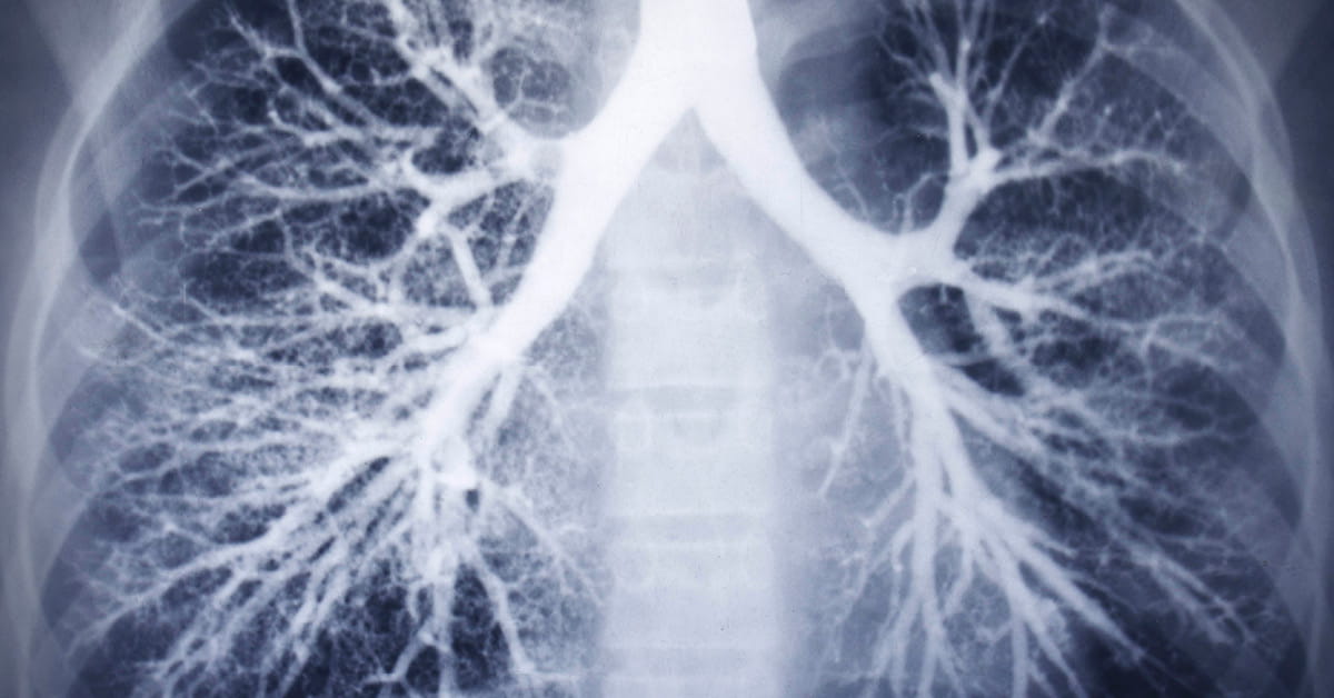 What Does Coronavirus Do to the Lungs? | Houston Methodist On Health