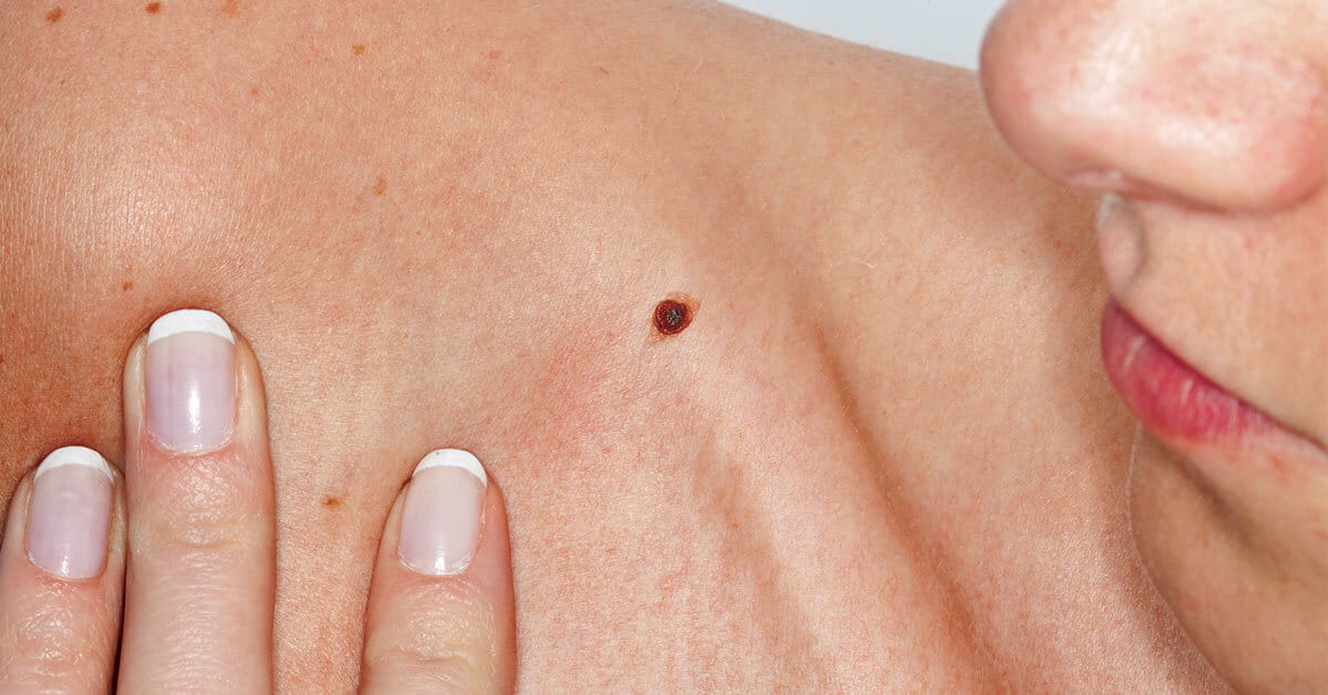 When Should I Worry About a Mole? | Houston Methodist On Health