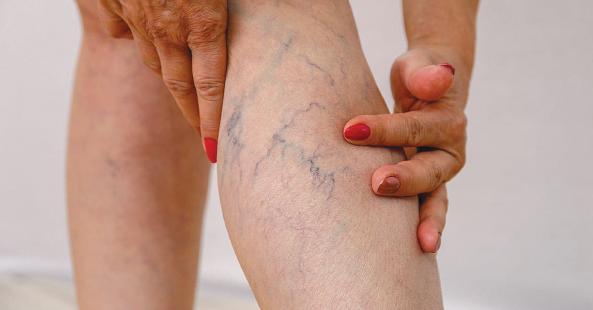 When Should I Worry About Varicose Veins? | Houston Methodist On Health