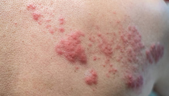 Shingles Qanda Is Shingles Contagious And Everything Else You Need To Know