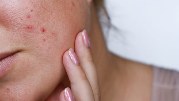 Pregnancy Acne: Why It Happens & How to Get Rid of It