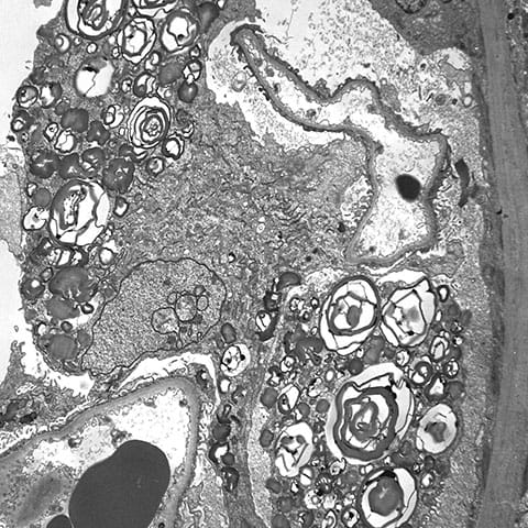 Zebra bodies in Fabry disease