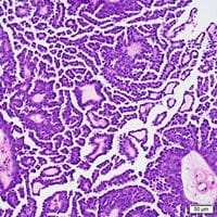 Serous borderline tumor with micropapillary pattern