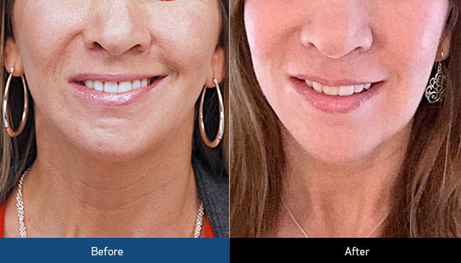 botox-treatment-before-and-after