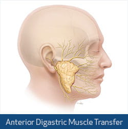 digastric muscle transfer illustration