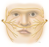 cross face nerve graft illustration