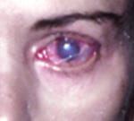 keratitis