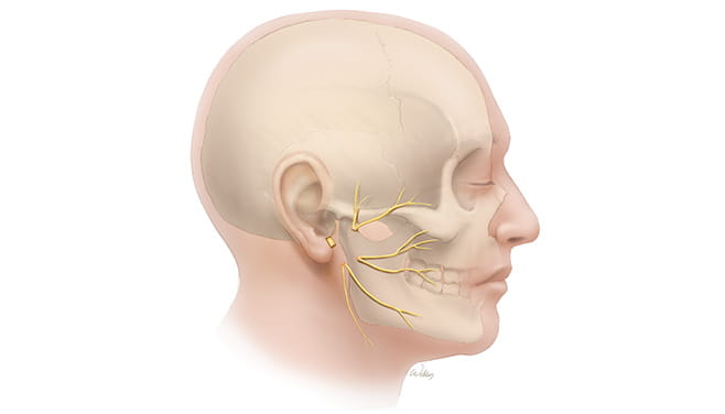 Segmental Defect Facial Nerve
