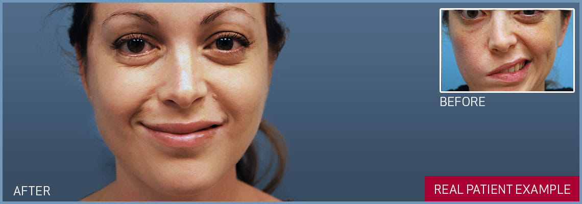 masseter facial nerve transfer banner