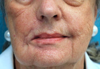 lip symmetry procedure