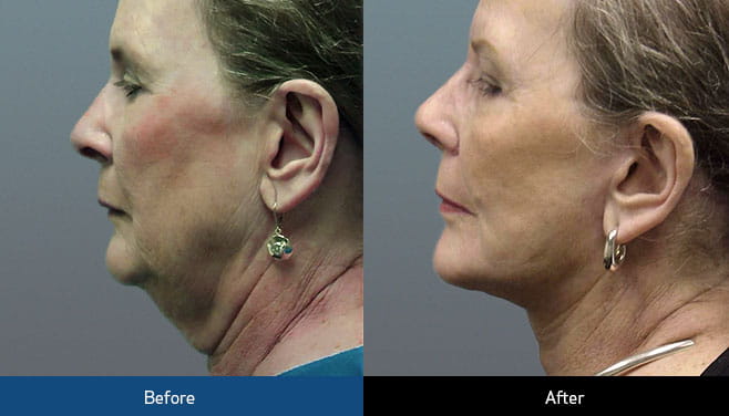 neck lift before and after