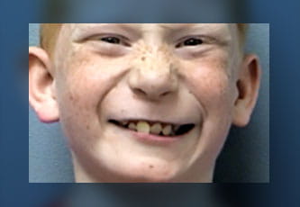 myectomy video image