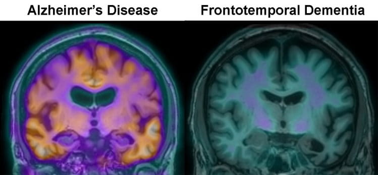 Using specialized PET imaging, researchers at Houston Methodist are able to identify accumulations of the protein beta amyloid in the brain of Alzheimer's patients, shown in yellow in the scan on the left. Beta amyloid is not present in the brains of patients with frontotemporal dementia, as shown in the scan on the right. 