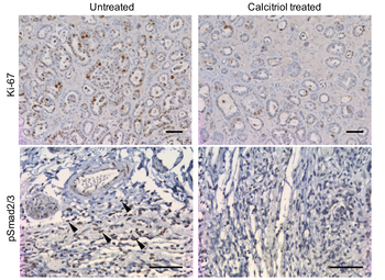 Scientists discovered a pathway that plays a significant role in the progression of ovarian cancer and then identified an existing drug to block this pathway. The drug – a synthetic, active form of vitamin D called Cacitriol – prolonged survival and reduced tumor growth. 