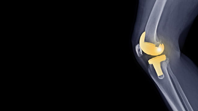 Scan of knee replacement