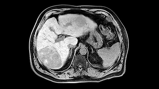 Researchers Identify B Cells as Driver of Immunotherapy Resistance in ...