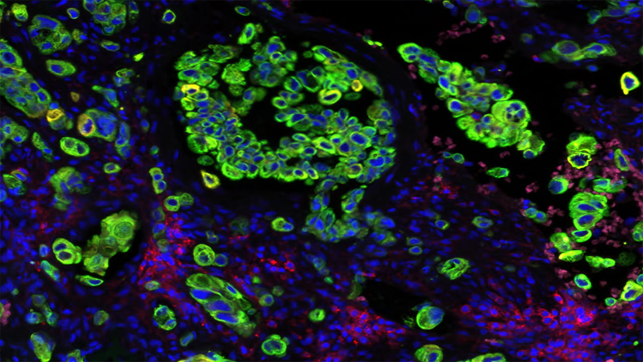 Microscope image of human brain metastasis tissue. 