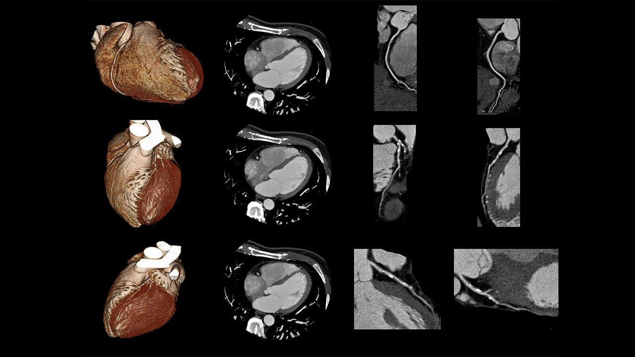 anatomy depicting AAOLCA