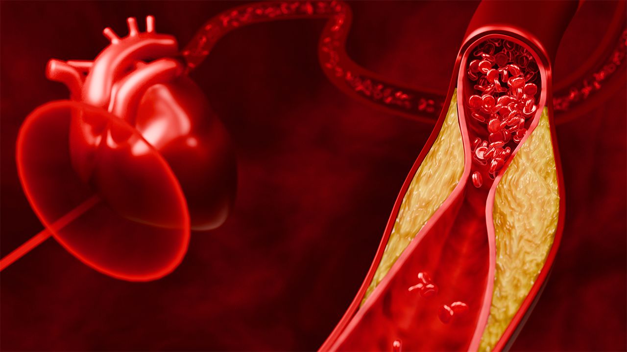 graphical depiction of cholesterol buildup