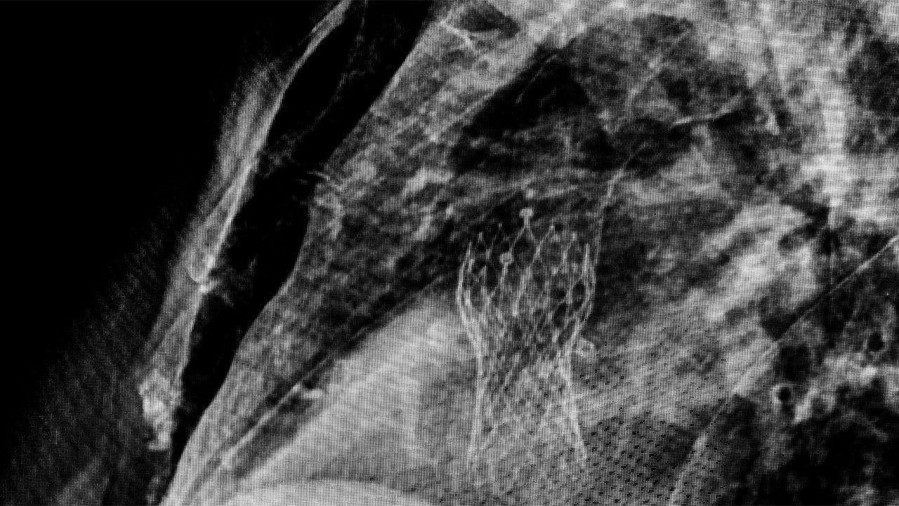 Black and white diagnostic image closeup of a mesh TAVR replacement valve placed in a patient's heart.