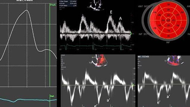 Diagnostic imaging of a more accurate method for estimating left ventricular filling pressure. 
