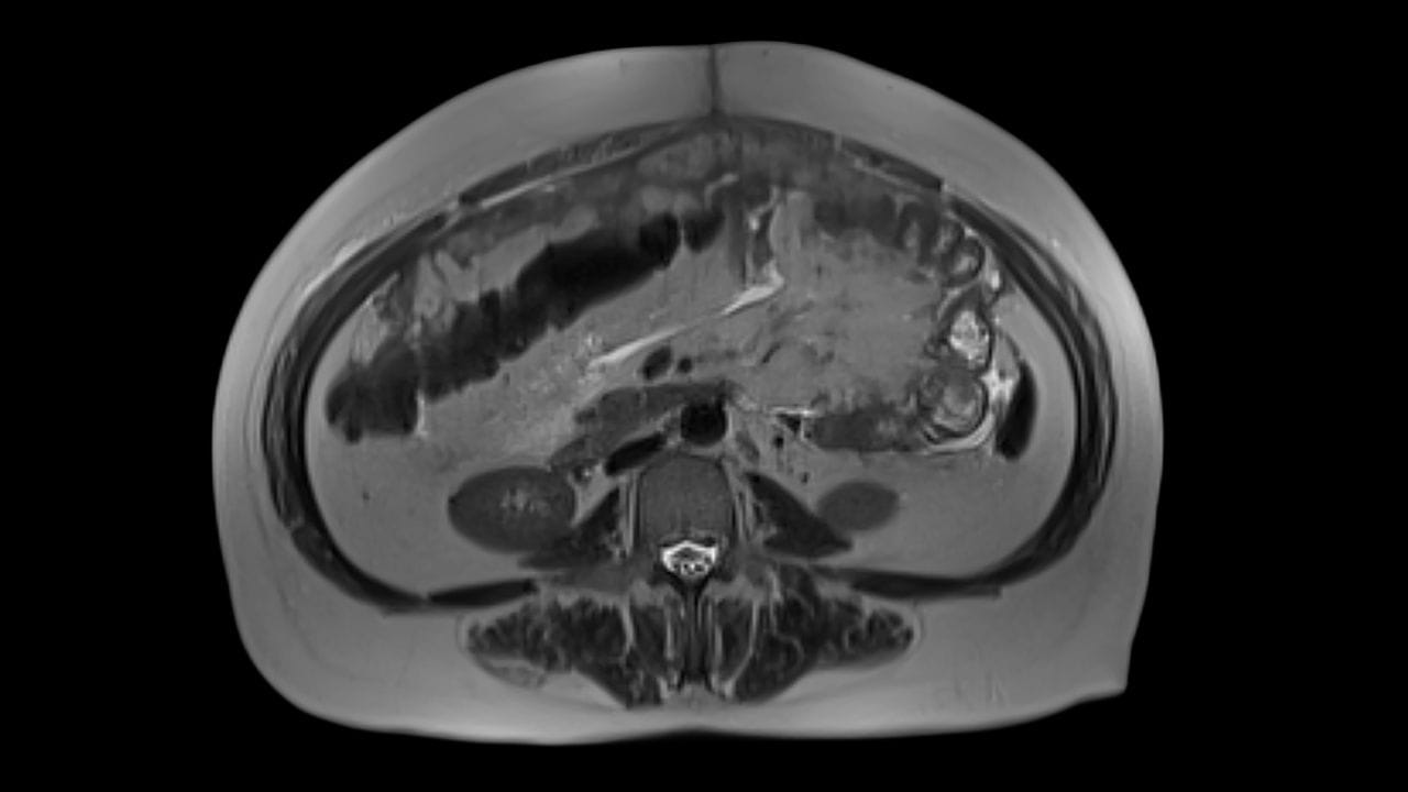 Black and white diagnostic image shows a common malignant type of ovarian carcinoma.