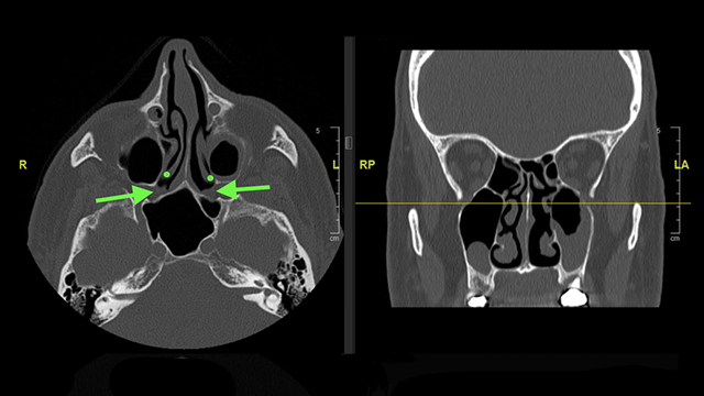 Researchers Improve Success Rates for Chronic Rhinitis Treatments with ...