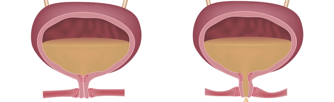 Illustration of overactive bladder