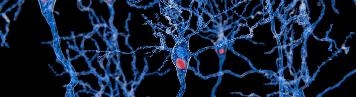 Microscopic-style illustration of interconnected blue nerve cells and branching neural pathways against a black background, with several cell bodies highlighted in red, suggesting changes or abnormalities within brain tissue.