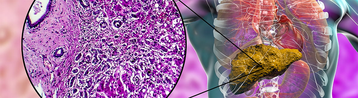 Redefining Transplant Oncology: Dr. Sudha Kodali and the Expansion of What’s Possible