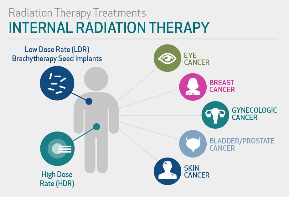 Radiation Therapy: Internal & External Radiation