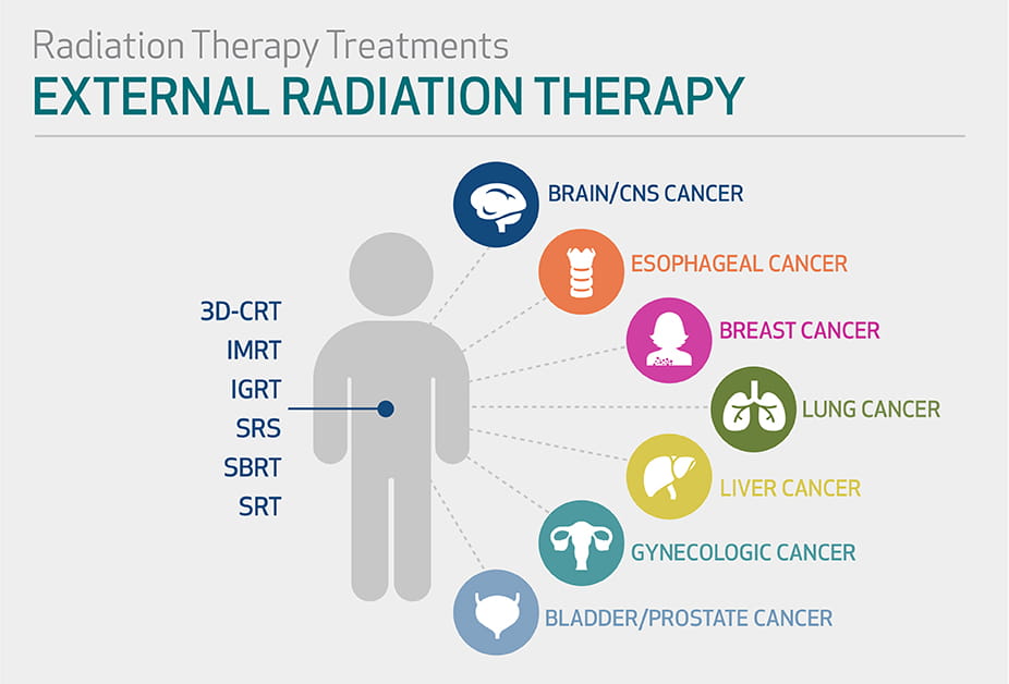 Radiation Therapy Internal And External Radiation Houston Methodist