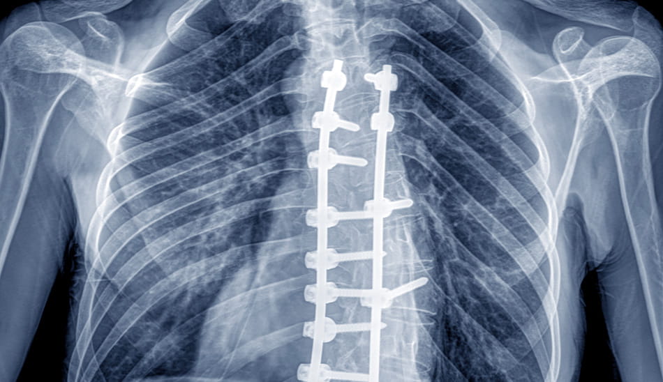 X-ray image of a patient’s spine after spinal fusion surgery, showing implanted hardware.