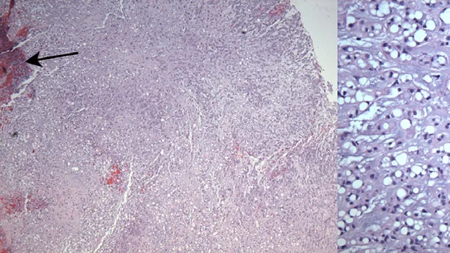 image of a chordoma tumor microscopic