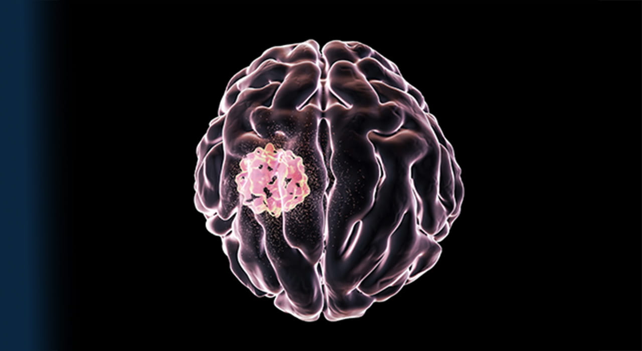 Glioblastoma Study Improves Understanding of How Immune Cells Function in the Brain