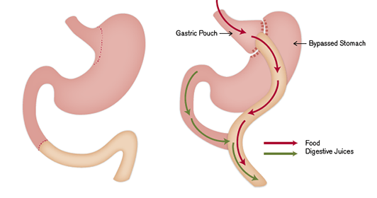 Roux-en-Y Gastric Bypass Image