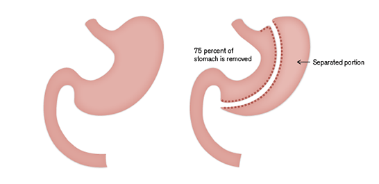 Sleeve Gastrectomy Image