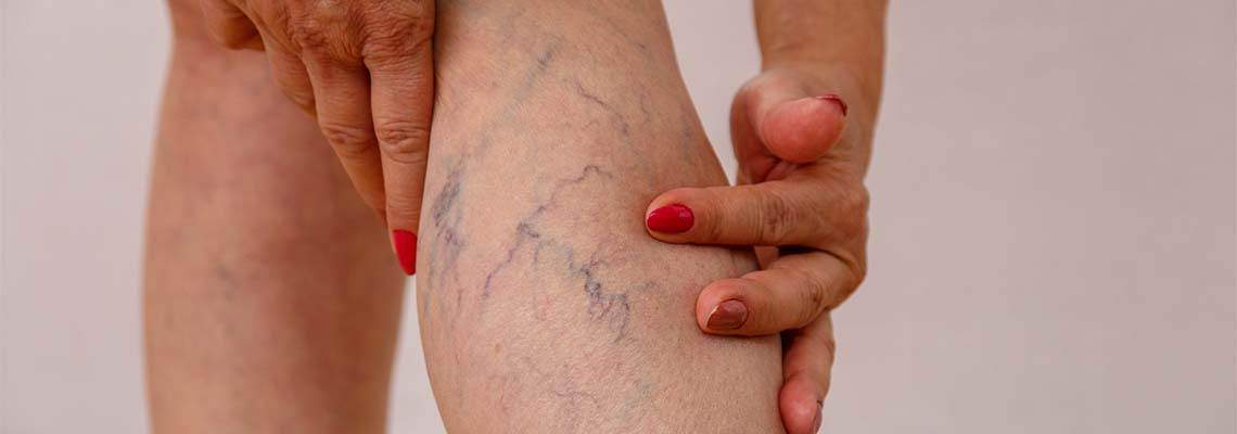 Varicose veins on leg